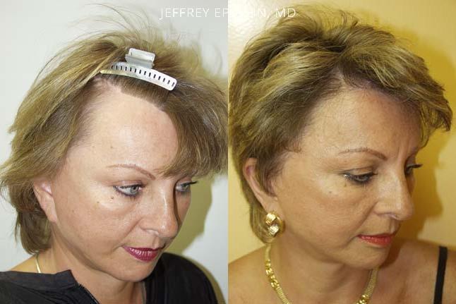 Facelift Scar repair before and after photo of patient 2, oblicue view