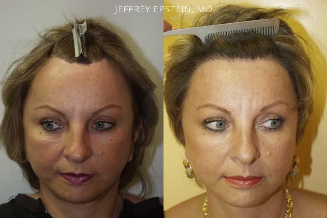 Facelift Scar repair before and after photo of patient 2, frontal view