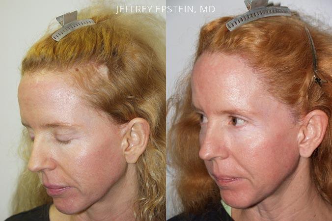 Facelift Scar repair before and after photo of patient 3, oblicue left view