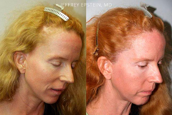 Facelift Scar repair before and after photo of patient 3, oblicue view