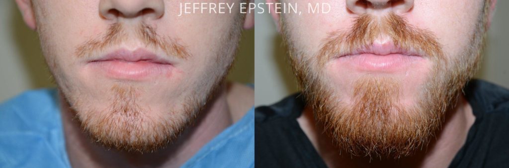 Before and after 1800 grafts to beard