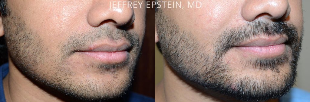 Before and after 2400 FUE grafts transplanted to the beard