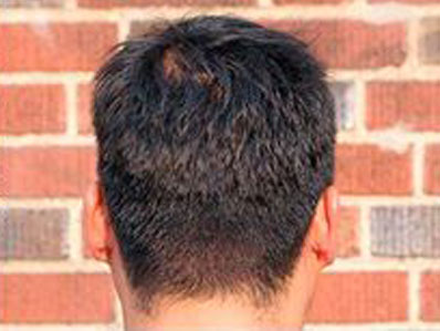 Just eight days after the hair transplant with full healing of the FUE donor area