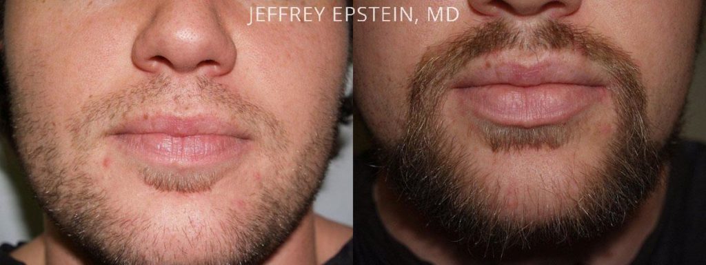 BEFORE AND AFTER ONE PROCEDURE OF 850 GRAFTS TO THE GOATEE