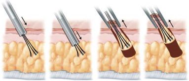  Illustration of the follicular unit extraction technique 