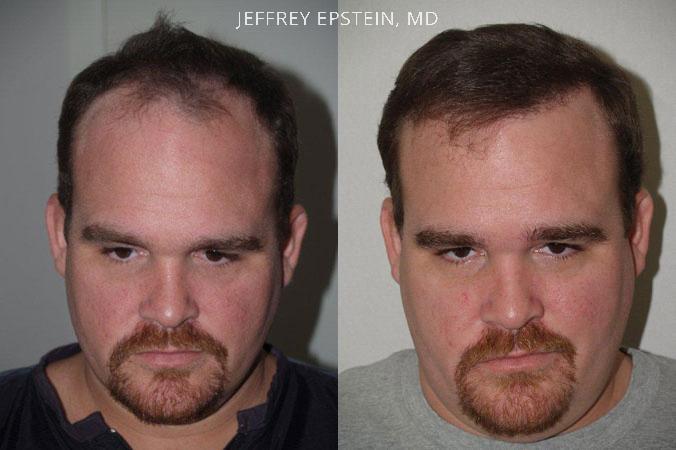 Before and after one procedure of 3,400 grafts