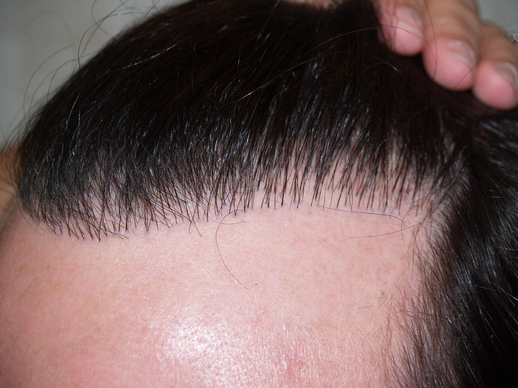Before, two days after and one year after FUE removal of more than 700 unaesthetic prior placed grafts into the hairline after photo