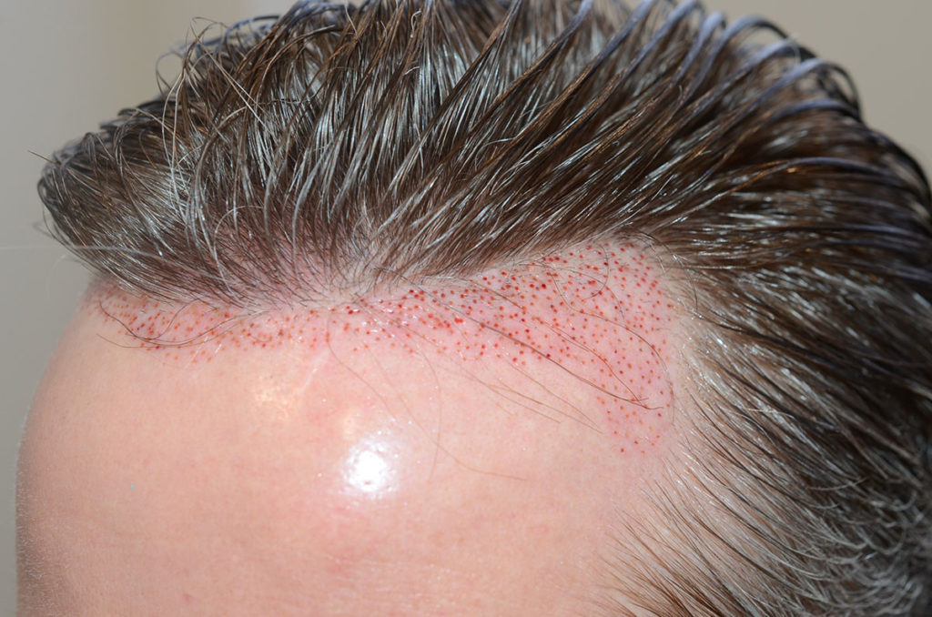 FUE removal of 450 prior placed grafts that were placed too low. The patient desired a more conservative natural-appearing hairline. 1 day after photo