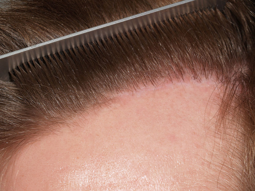 Another example of surgical hairline excision- in this case, only a portion of the hairline was excised after photo