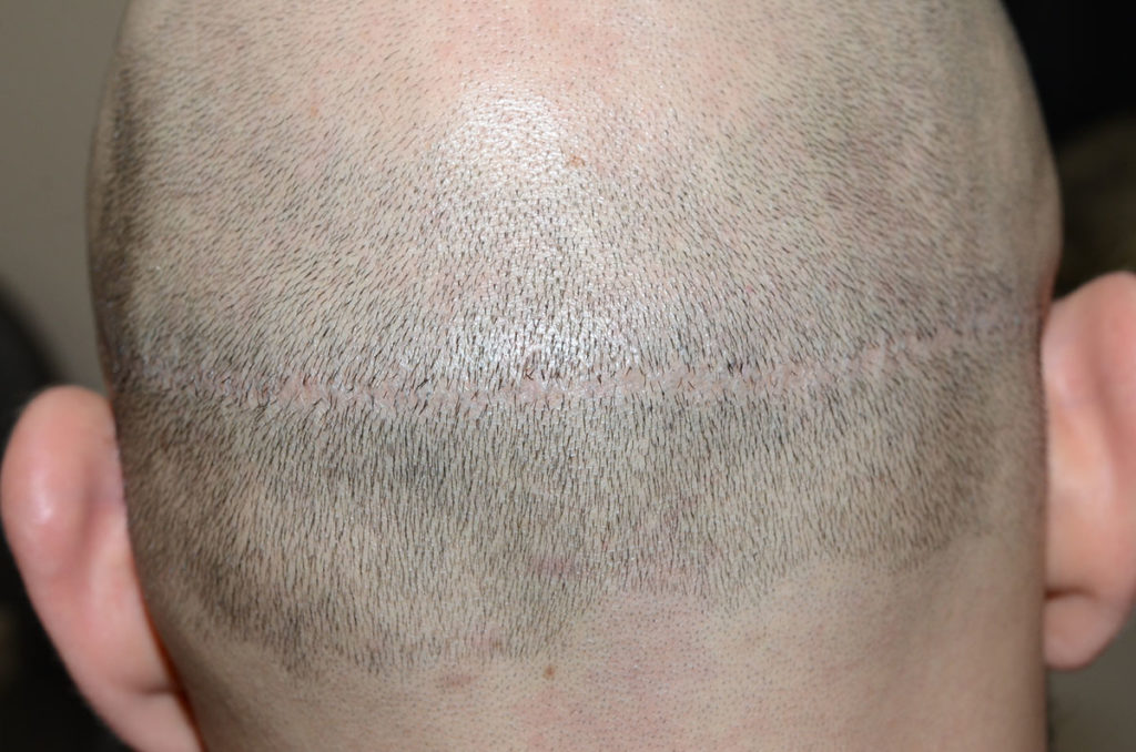 Before and after FUE hair grafting into a prior linear donor site scar after photo