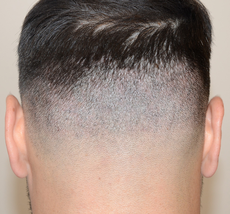 SMP- scalp micropigmentation- done into prior FUE donor site after photo