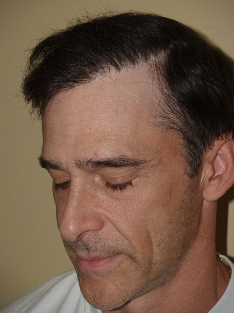 After total hairline excision procedure. This patient had an unacceptable amount of scarring along with unnatural plug grafts along the hairline
