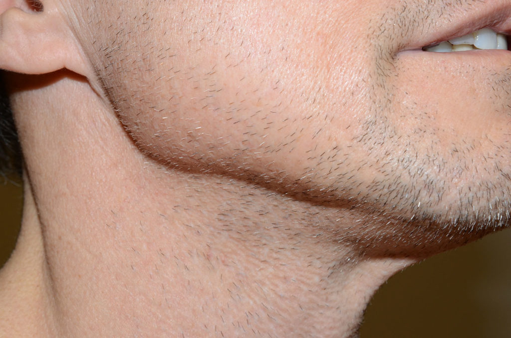 The transplanting of beard hairs to create a more natural appearance. In this case, the beard hairs were required due to insufficient scalp donor hairs after photo
