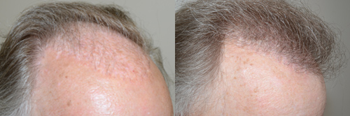 This patient had undergone prior transplants more than 20 years prior, and the grafts after many years stopped growing due to overgrowth of scarring in the recipient area. oblicue view