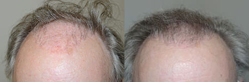 This patient had undergone prior transplants more than 20 years prior, and the grafts after many years stopped growing due to overgrowth of scarring in the recipient area. frontal view