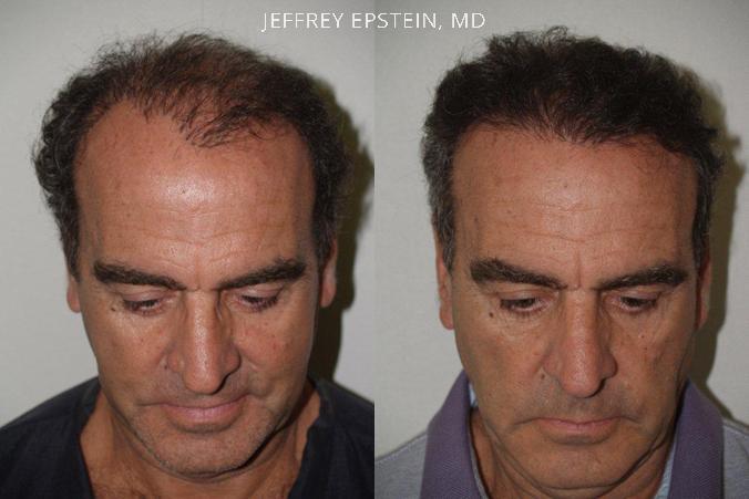 Hair reparative procedure frontal view before and after 