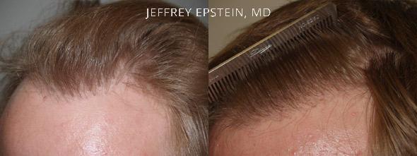 In this patient, the unnatural hairline was improved with the transplanting of additional grafts to make it appear softer and more feathered.