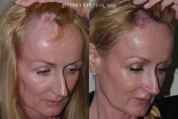 Hair reparative procedure oblicue view before and after patient 2
