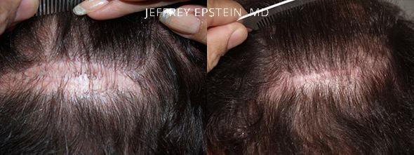 Before and after excision and plastic surgery closure of a prior donor site scar.