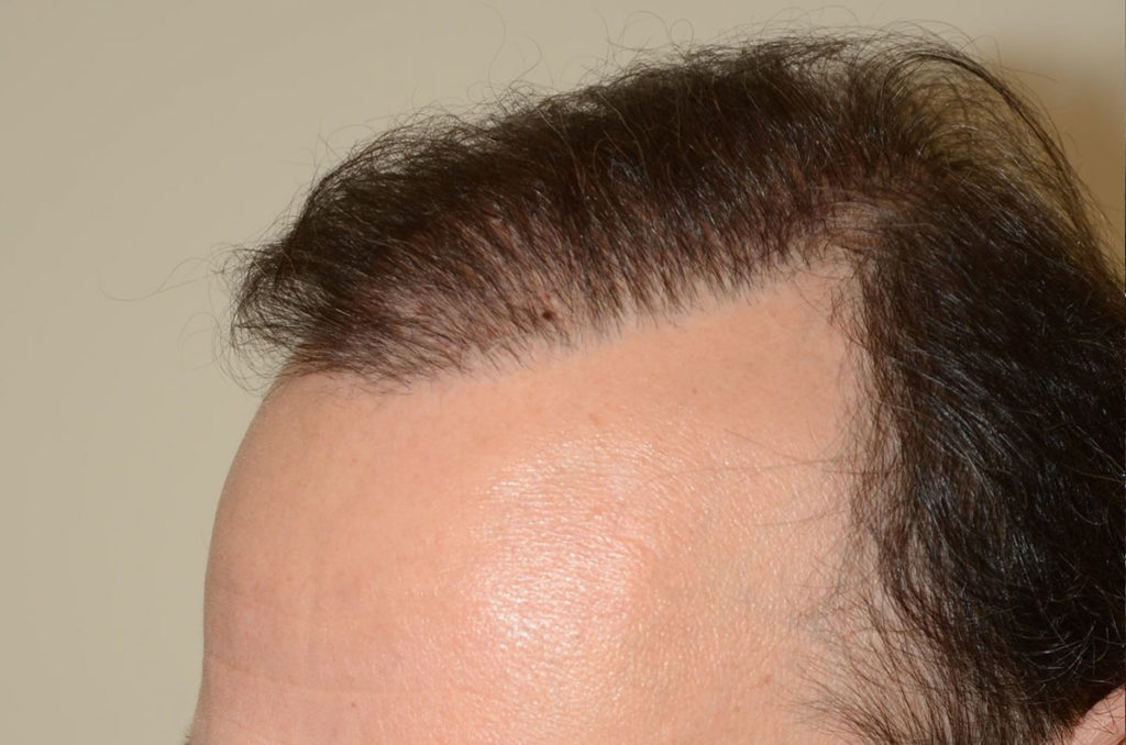 The transplanting of beard hairs to create a more natural appearance. In this case, the beard hairs were required due to insufficient scalp donor hairs before photo