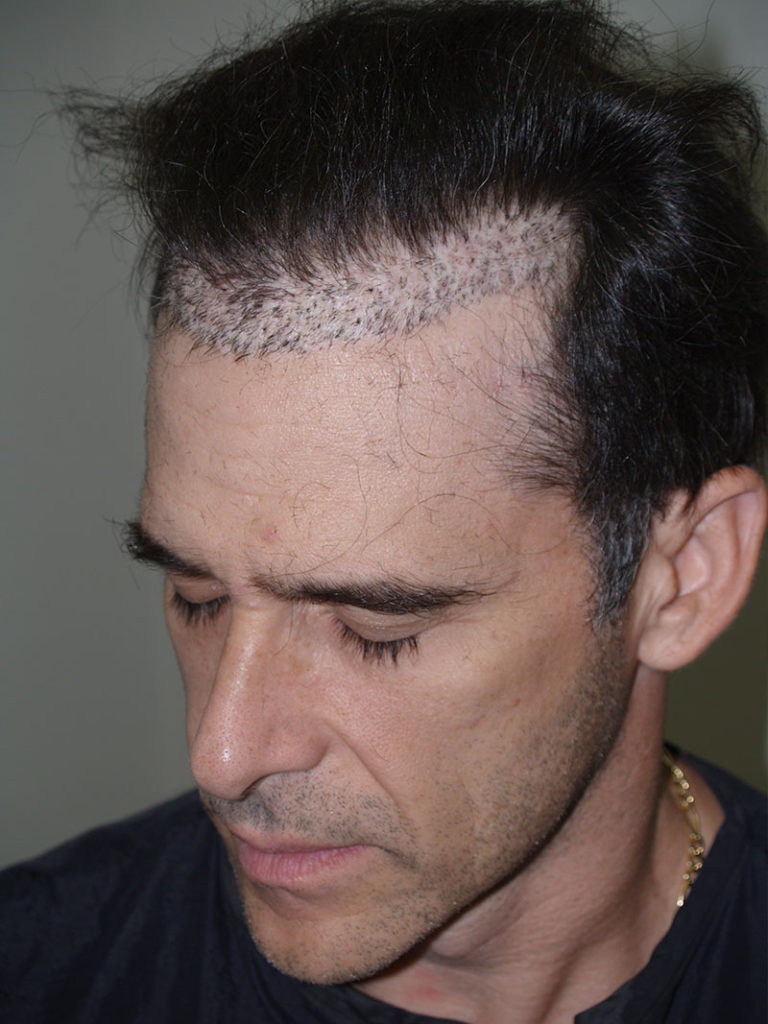 Before and one year after total hairline excision procedure. This patient had an unacceptable amount of scarring along with unnatural plug grafts along the hairline