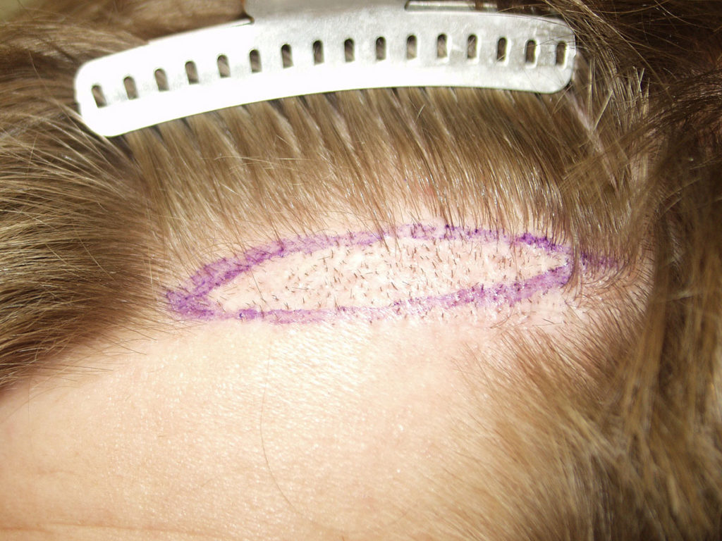 Another example of surgical hairline excision- in this case, only a portion of the hairline was excised marked photo