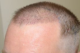 At just one day after an FUE procedure, when performed properly, healing has already begun 1 day frontal view