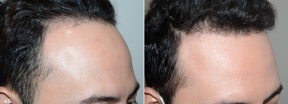 Hair Transplants for Men Before and after in Miami, FL, Paciente 109730