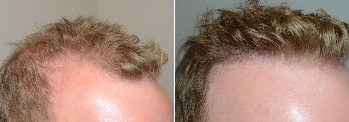 Hair Transplants for Men Before and after in Miami, FL, Paciente 109991