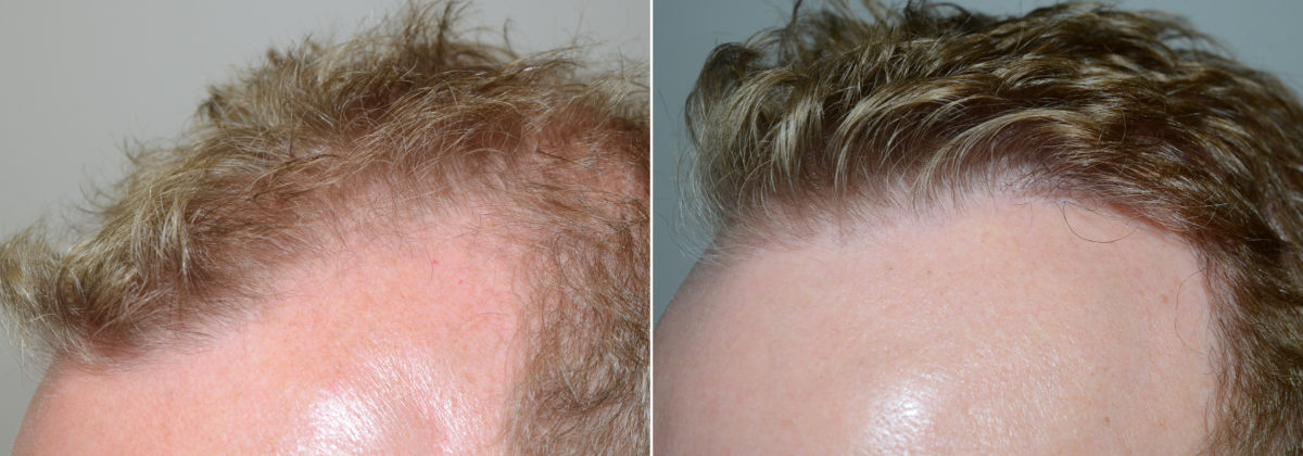 Hair Transplants for Men Before and after in Miami, FL, Paciente 109991