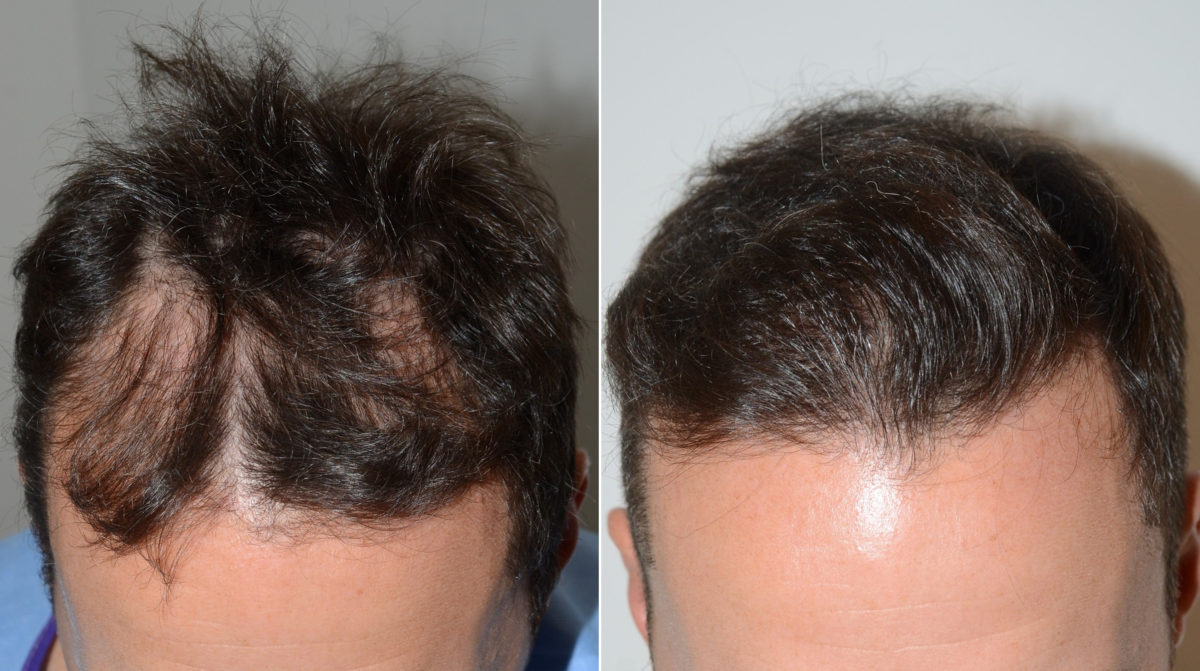 Hair Transplants for Men Before and after in Miami, FL, Paciente 110211