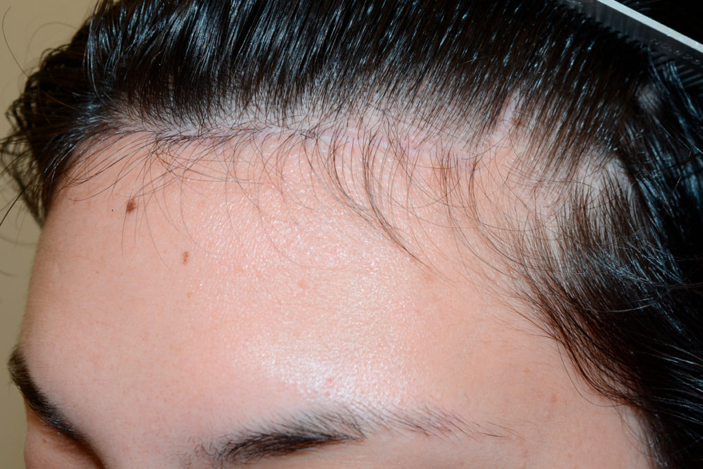 24 year old patient born with high hairline. Underwent the surgical hairline advancement surgery, where her forehead was reduced in size by 1 1/4 inches oblicue after view