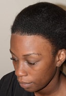 Before and After Hairline Advancement /Forehead Shortening Surgery facilitated by tissue expansion, followed by 1500 grafts to round out the hairline oblicue after view