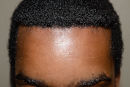 This African American patient in his late 20s desired a lower hairline, so he underwent a surgical hairline advancement (SHA) that brought forth his hairline a full 1 ½ inch, or more than 35mm after frontal view