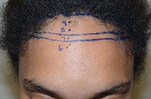 Here the scalp is being firmly pushed forward by as far as it can go, showing fairly good to very good scalp laxity, which will permit, after some additional surgical steps to further loosen the scalp, allow the hairline to be brought forward and down by approximately 3cm marked view