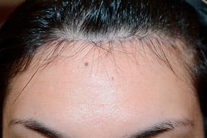 24 year old patient born with high hairline. Underwent the surgical hairline advancement surgery, where her forehead was reduced in size by 1 1/4 inches after frontal view