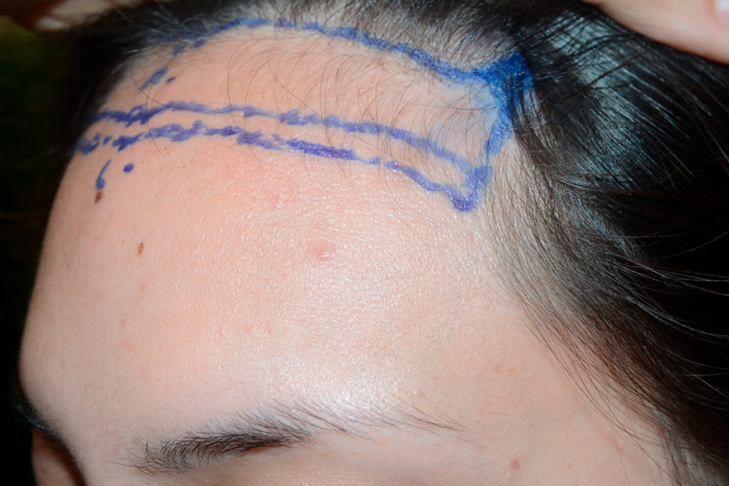 24 year old patient born with high hairline. Underwent the surgical hairline advancement surgery, where her forehead was reduced in size by 1 1/4 inches oblicue before view
