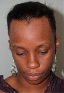 Before and After Hairline Advancement /Forehead Shortening Surgery facilitated by tissue expansion, followed by 1500 grafts to round out the hairline frontal before view