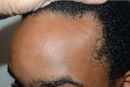 This African American patient in his late 20s desired a lower hairline, so he underwent a surgical hairline advancement (SHA) that brought forth his hairline a full 1 ½ inch, or more than 35mm oblicue before view