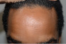 This African American patient in his late 20s desired a lower hairline, so he underwent a surgical hairline advancement (SHA) that brought forth his hairline a full 1 ½ inch, or more than 35mm. before frontal view