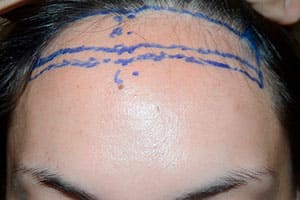 24 year old patient born with high hairline. Underwent the surgical hairline advancement surgery, where her forehead was reduced in size by 1 1/4 inches before frontal view