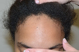 Here the scalp is being firmly pushed forward by as far as it can go, showing fairly good to very good scalp laxity, which will permit, after some additional surgical steps to further loosen the scalp, allow the hairline to be brought forward and down by approximately 3cm before view