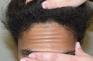 Here the scalp is being firmly pushed forward by as far as it can go, showing fairly good to very good scalp laxity, which will permit, after some additional surgical steps to further loosen the scalp, allow the hairline to be brought forward and down by approximately 3cm frontal view