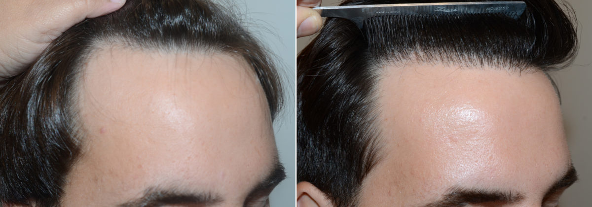 Hair Transplants for Men Before and after in Miami, FL, Paciente 109947