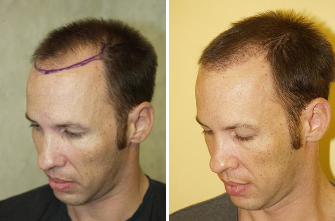 Hair Transplants for Men Before and after in Miami, FL, Paciente 38037