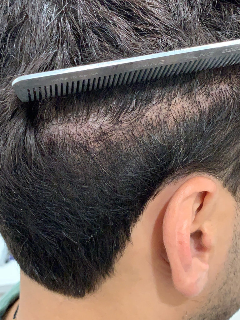Scalp micropigmentation after man oblicue view picture
