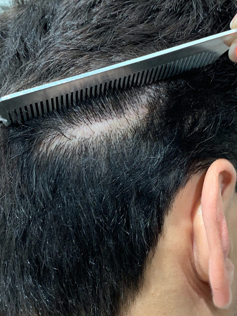 Micropigmentación del cuero cabelludo antes de que el hombre oblicue ver imagen