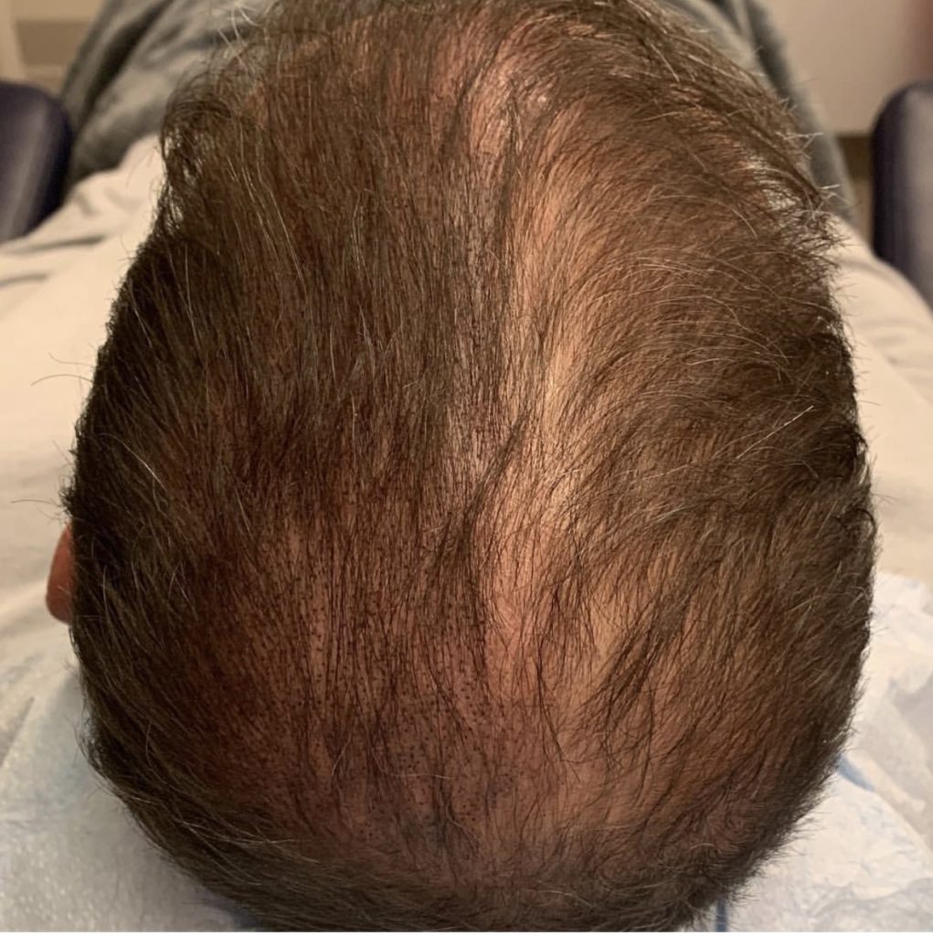 SMP is an excellent option for those patients who either don’t want or are not eligible for hair transplantation surgery, or as a complementary procedure for those who want the appearance of thicker, fuller hair.