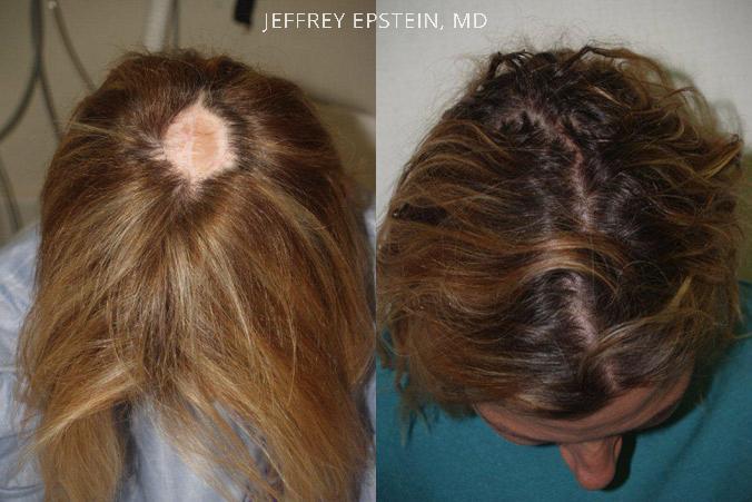 One rather advanced plastic surgery procedure of the scalp in which Dr. Epstein specializes is tissue expansion. What tissue expansion involves is essentially the stretching out of a portion of the scalp—and sometimes the forehead or other area