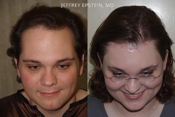 Antes y diez meses después de 2.750 injertos vista frontal